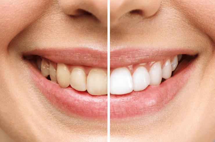 Teeth Whitening